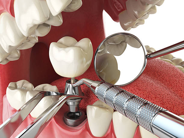 Best Teeth Whitening  in Bourbon, IN